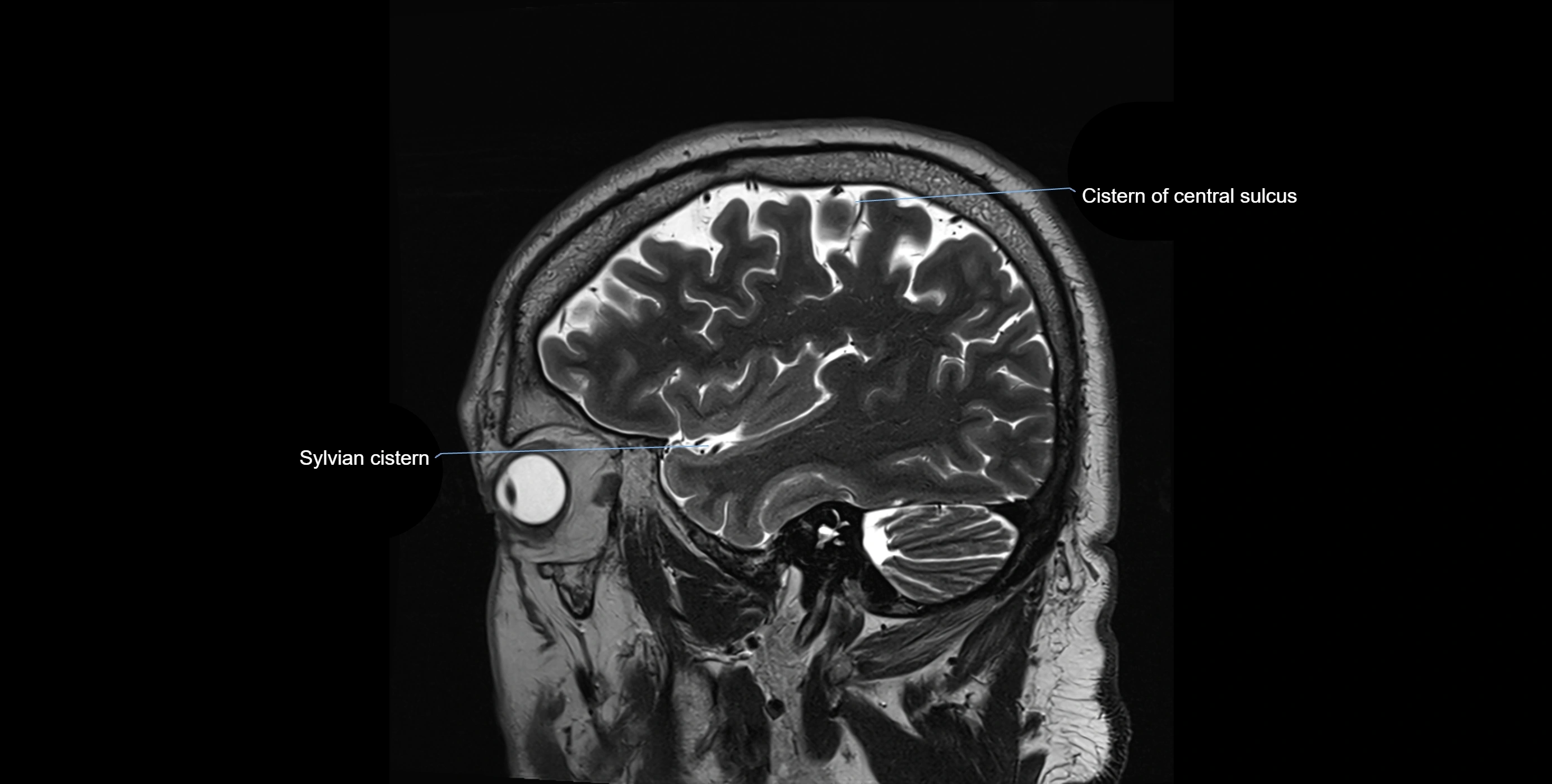 Brain cisterns  and ventricles sagittal anatomy 3T MRI image-img-00001-00011.webp